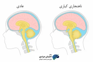 تصویر علائم بیماری کیاری