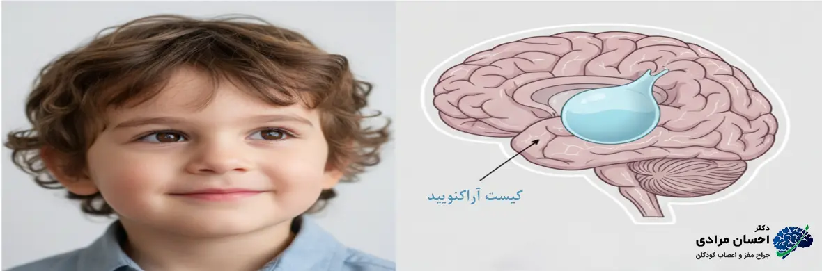 کیست آراکنویید