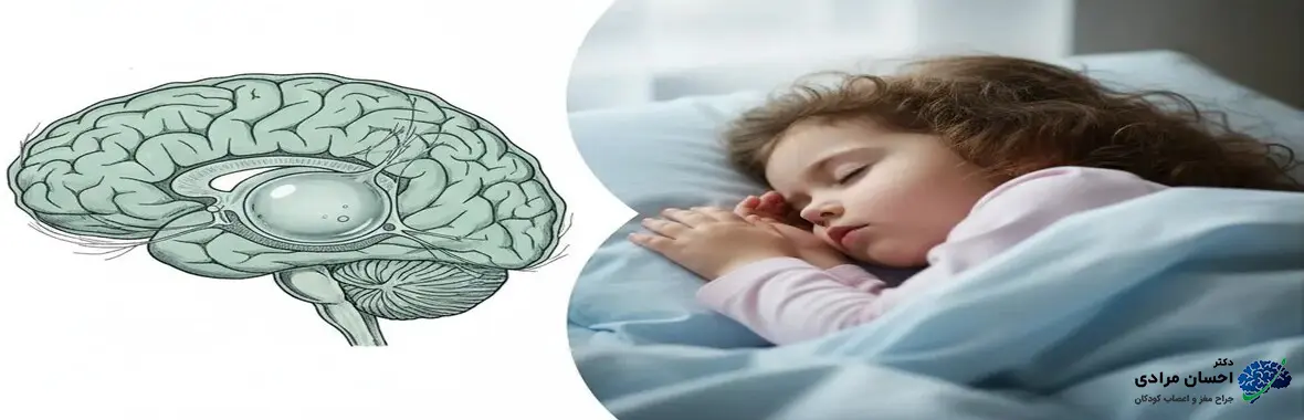 کیست آراکنوئید