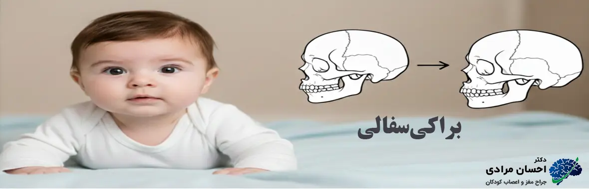 براکی‌سفالی