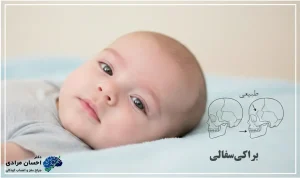 براکیسفالی