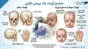 تصویر آموزشی سندرم آپرت شامل مقایسه جمجمه و دست نوزاد سالم و مبتلا با نمایش کرانیوسینوستوز، کمرشدی میدفیس، برجستگی پیشانی و چسبندگی انگشتان.