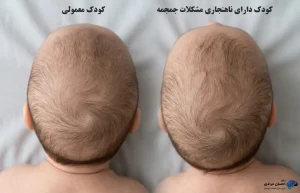 مقایسه فرم طبیعی جمجمه نوزاد با بد شکلی سر