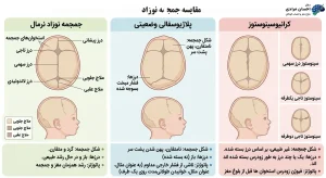 تفاوت پلاژیوسفالی و کرانیوسینوستوز