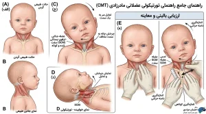 تصویر شماتیک تورتیکولی مادرزادی نوزاد و کوتاهی عضله استرنوکلیدوماستوئید