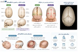 اسکافوسفالی در نوزاد؛ علائم، علت و درمان بسته شدن زودرس درز ساژیتال جمجمه