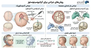 درمان اسکافوسفالی با جراحی آندوسکوپیک و بازسازی جمجمه