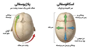 مقایسه اسکافوسفالی و پلاژیوسفالی در نوزاد از نمای بالا