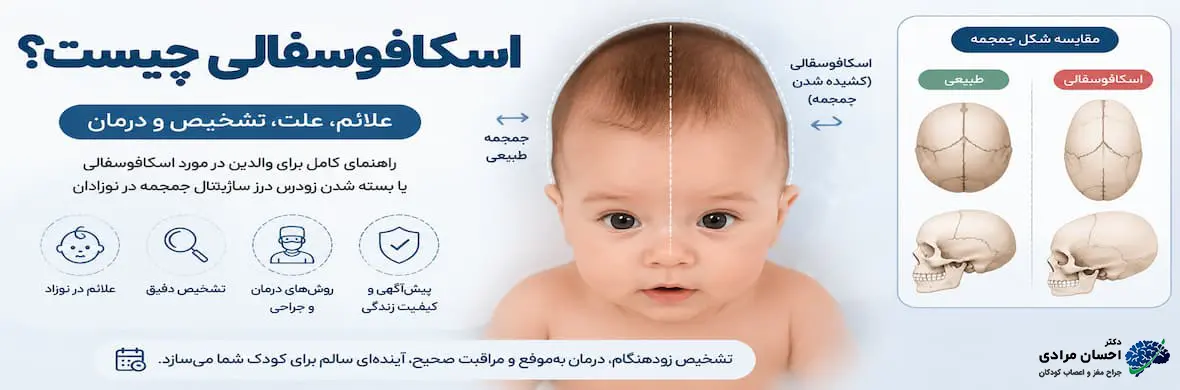 تصویر شماتیک اسکافوسفالی یا بسته شدن زودرس درز ساژیتال جمجمه در نوزاد