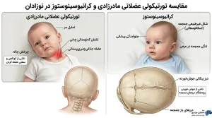 مقایسه تورتیکولی مادرزادی و کرانیوسینوستوز در نوزادان