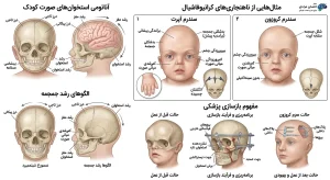 سندرم‌های کرانیوفاشیال و ناهنجاری‌های جمجمه و صورت کودکان