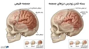 مقایسه جمجمه طبیعی کودک با کرانیوسینوستوز