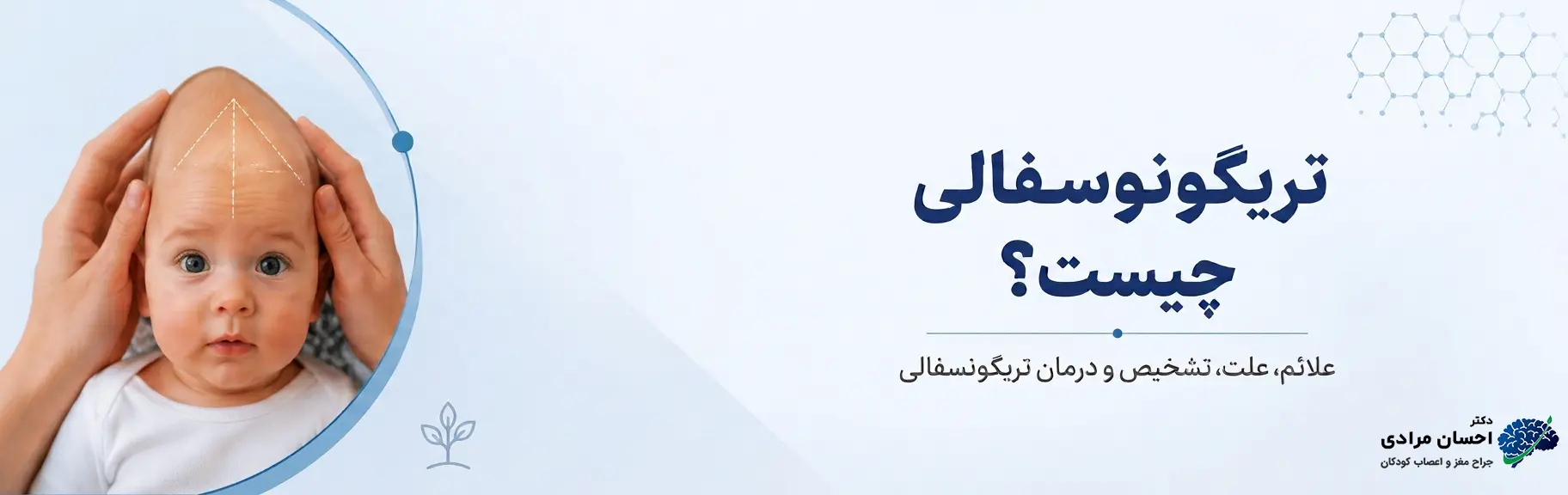 تصویر آموزشی تریگونوسفالی نوزادان با نمایش شکل مثلثی پیشانی، بسته شدن زودرس درز متوپیک و معرفی علائم، علت، تشخیص و درمان تریگونوسفالی