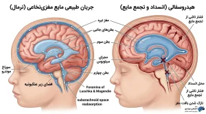 دیاگرام آناتومیک مقایسه جریان طبیعی مایع مغزی نخاعی و هیدروسفالی در مغز کودک