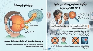اینفوگرافیک پزشکی پاپیلدم در کودکان، ارتباط تورم عصب بینایی با افزایش فشار داخل جمجمه و روش معاینه چشم‌پزشکی